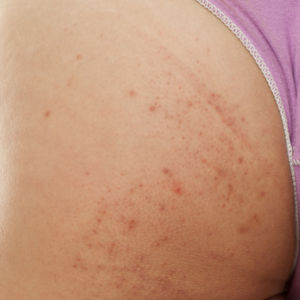 9 phương pháp điều trị tự nhiên cho mụn ở mông