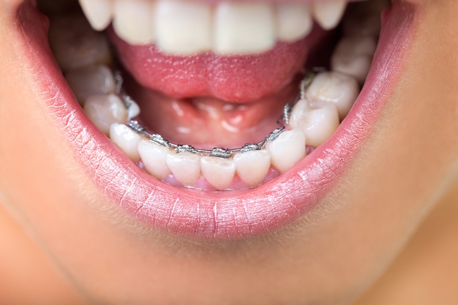 Invisalign Berlin Mitte – für ein funktionierendes Gebiss