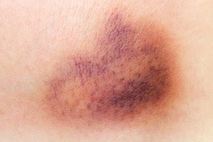 Giải thích bầm trên vú