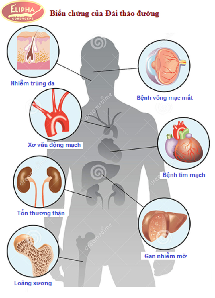 Bệnh Tiểu Đường Cần Kiêng Những Gì-Chuyên Gia Giải Đáp