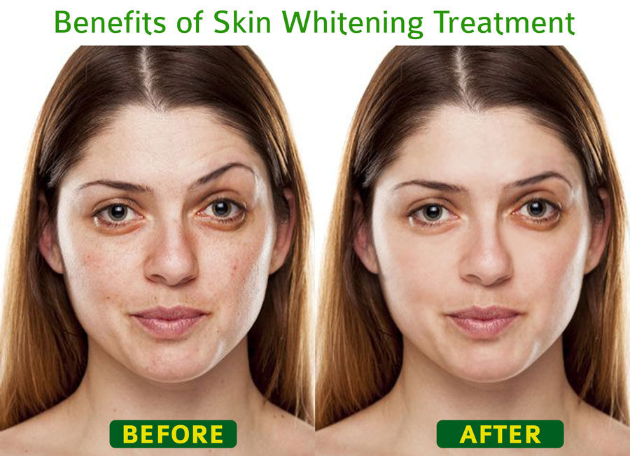 Skin whitening, laser skin treatment & skin tightening  in Gurgaon