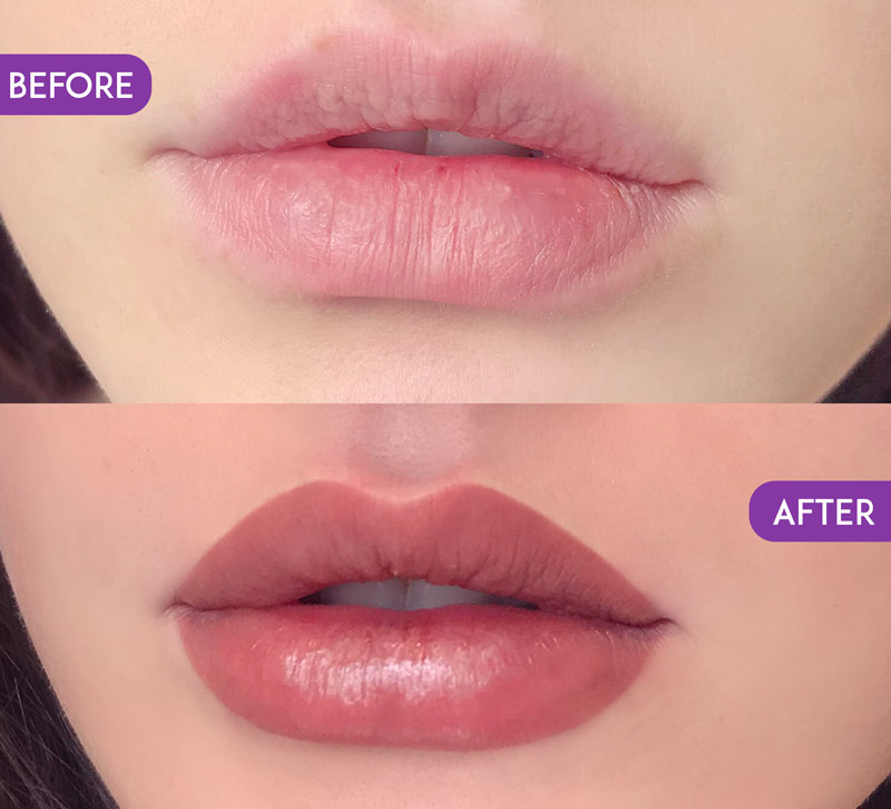 Lips Treatment | Truly Permanent Beauty in Kolkata
