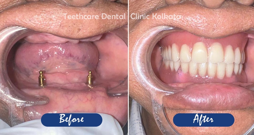 Full mouth Dental Implants in Kolkata | All in 4 dental implants