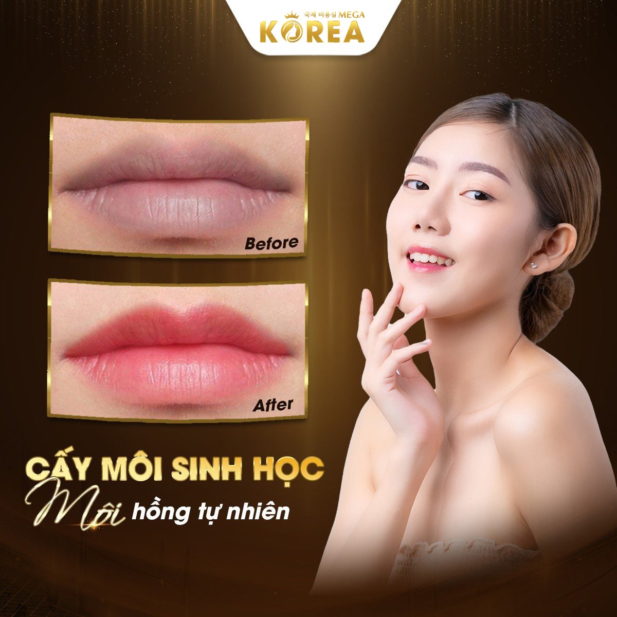 Cấy môi sinh học là gì? Có tốt không và cách chăm sóc sau cấy