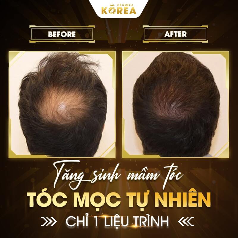 Tăng sinh mầm tóc vi bào StemCell - Cải thiện tóc rụng, tóc hói