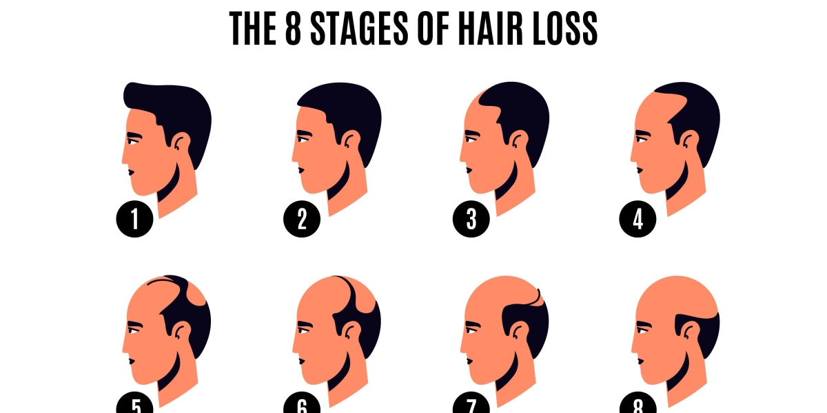 Is Hair transplant is good option ?