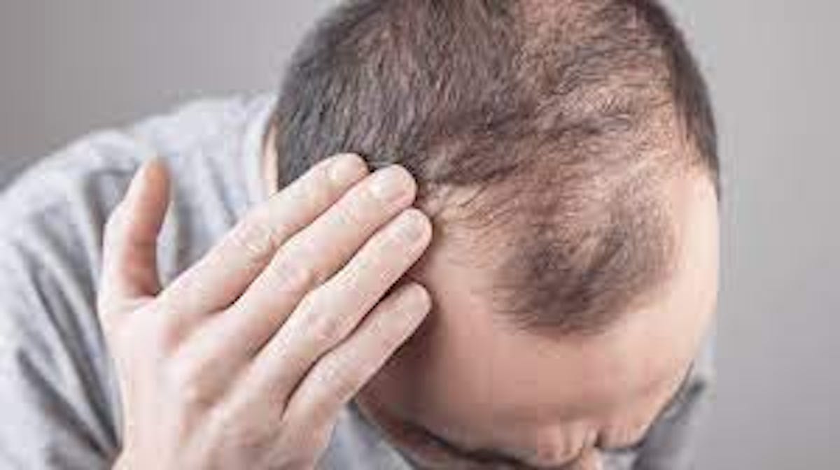 Here are 9 ways to PRP Hair Treatment in Dubai ****ter