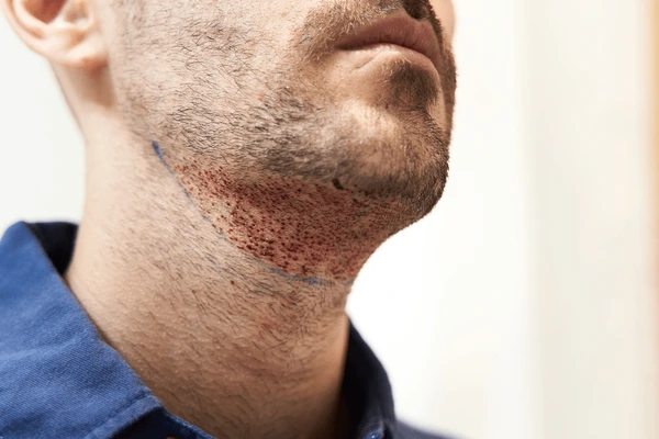 Get the Beard You’ve Always Wanted: Beard Hair Transplants in Dubai – Site Title