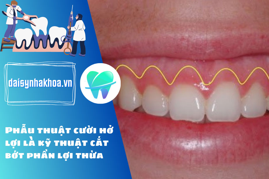 Phẫu thuật cười hở lợi ở đâu tốt? Chi phí như thế nào?