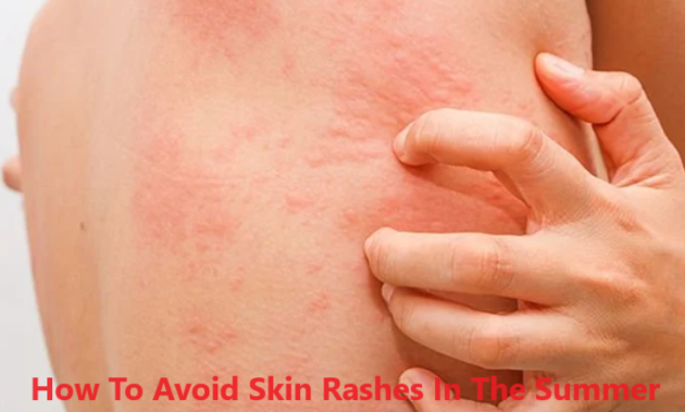 How To Avoid Skin Rashes In The Summer – Ehealthy99.com
