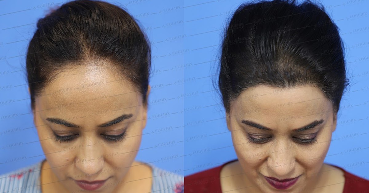 Reclaim Your Confidence with Hair Grafting in Dubai!