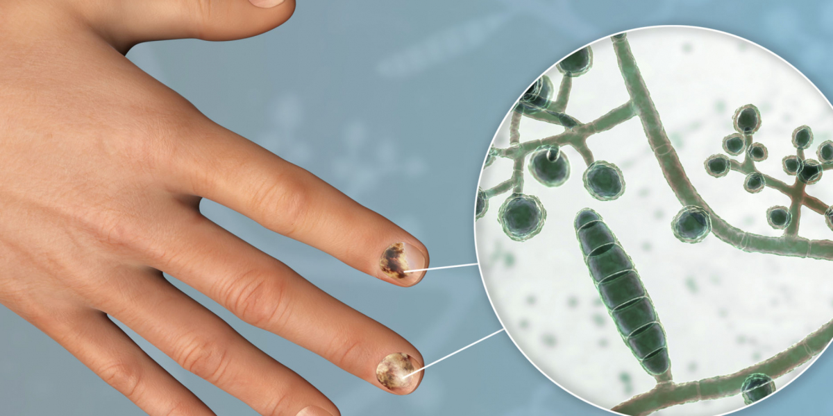Sanofi S.A. Develops Hybrid Antifungal Therapies: Bridging the Gap Between Natural and Synthetic Treatments