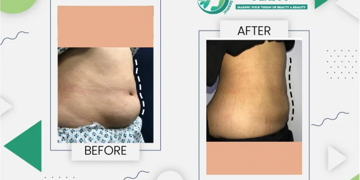 The Liposuction Cost in Pakistan