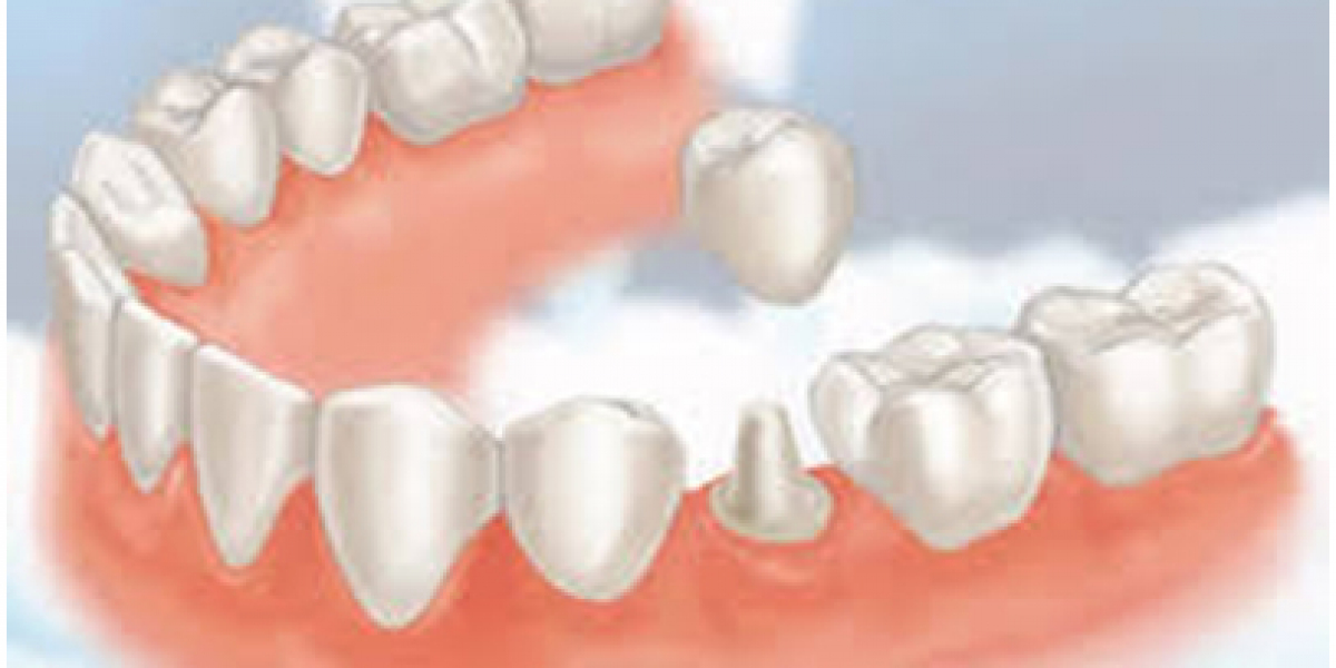 Best Diet for Strong Teeth: Natural Foods That Support Oral Health