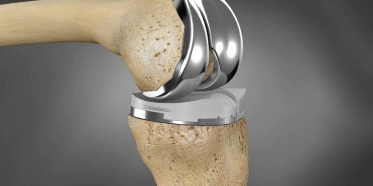 Artificial Implants Market 2031: Growth Factors, Competitive Landscape, and Share