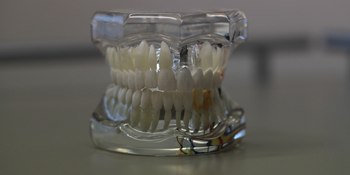 Regain Your Confidence with All-on-4 Dental Implants