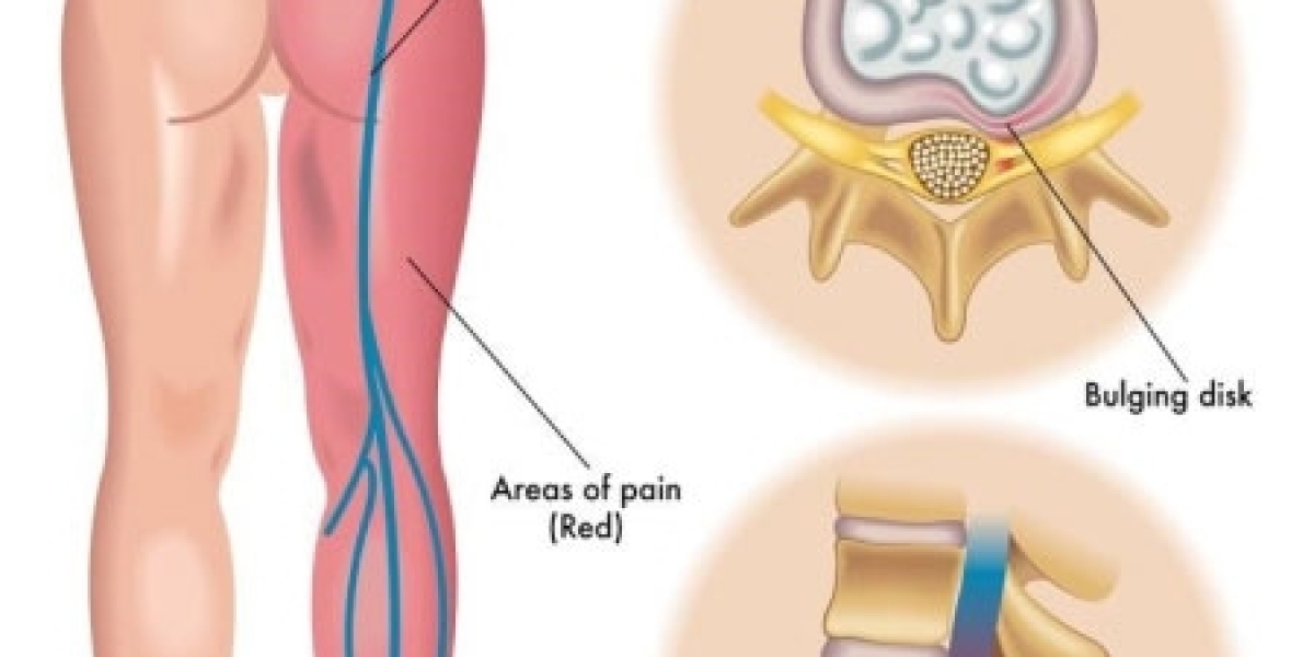 Diabetic Neuropathy Pain: Can Tapidol 50mg Help? – Complete Guide