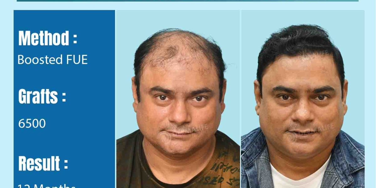 Why Hair Transplants Are the #1 Solution for Permanent Hair Loss