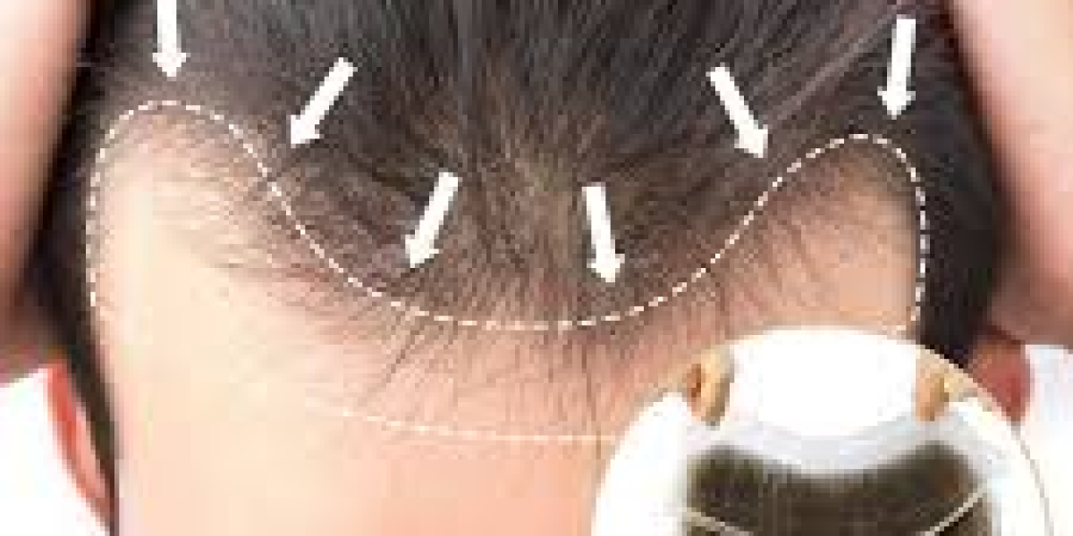 Regaining Natural Confidence with a Modern Hair Patch