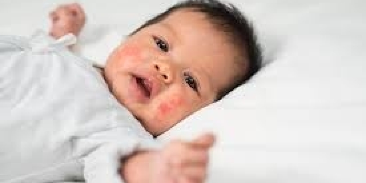 Atopic Dermatitis Market Outlook Focusing On Future Growth Trends And Therapeutic Developments Globally
