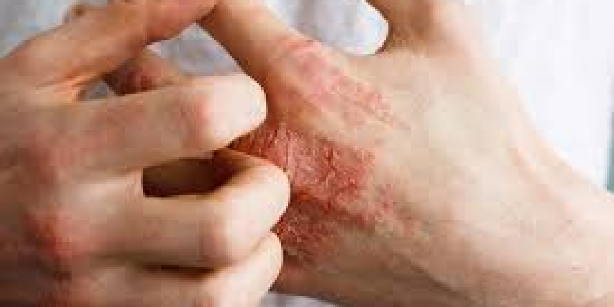 Atopic Dermatitis Market Driven by Biologic Therapies, Digital Health Tools, and Global Awareness