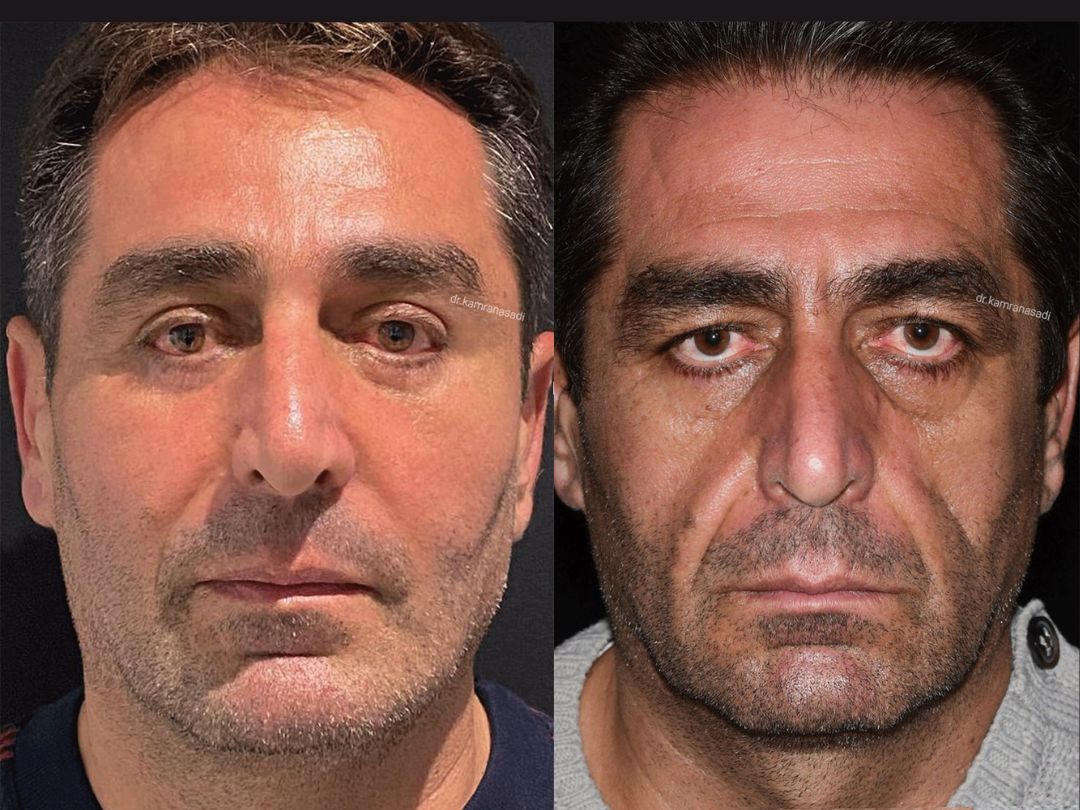 Endoscopic Forehead Lift Surgery UAE | Blue Angel Poly Clinic